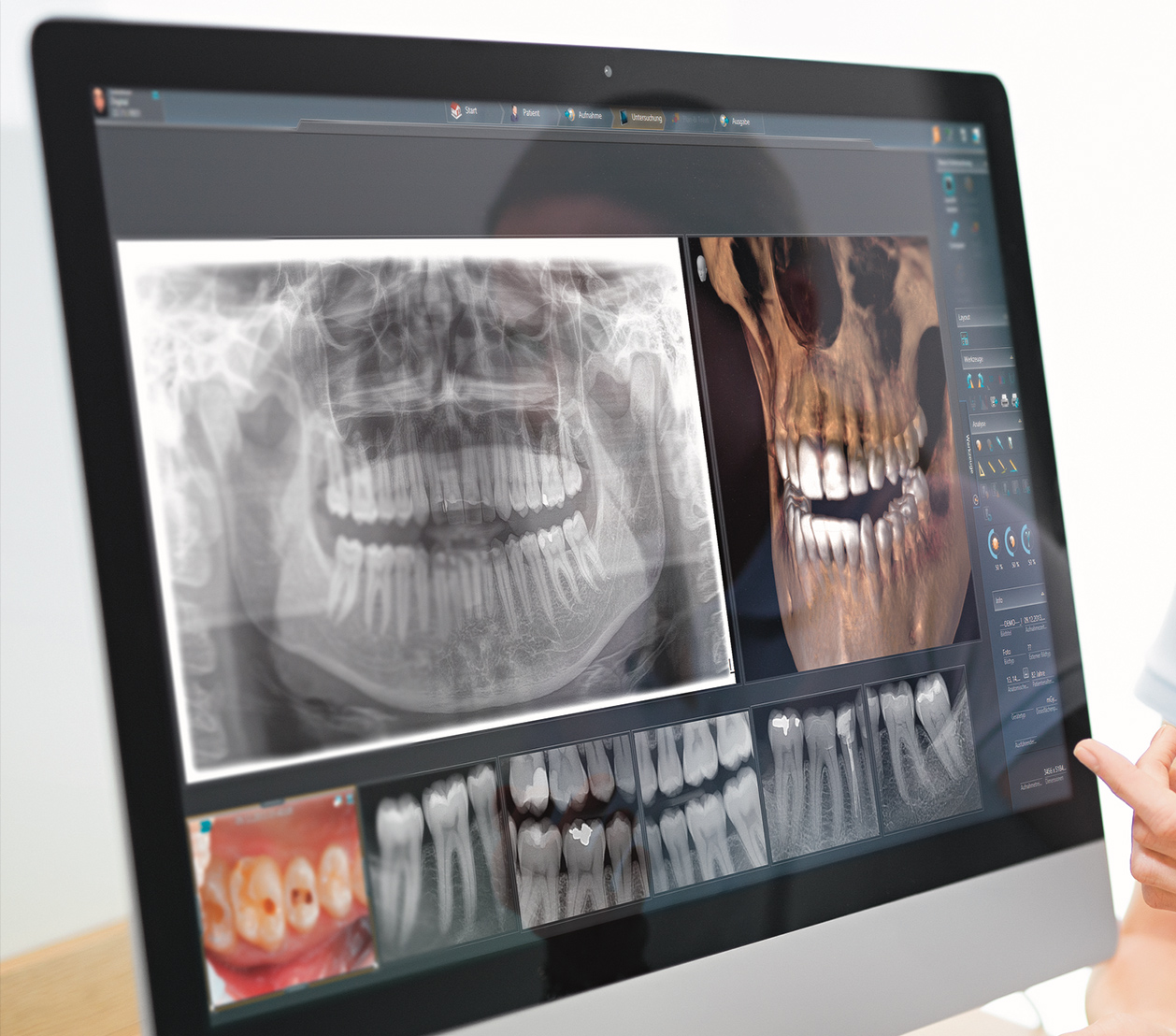 Dr. Zieger Zahnarzt Praxis Bonn Beuel 3D Röntgen DVT