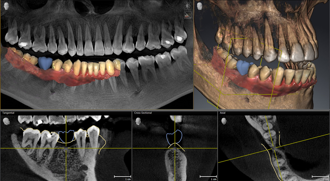 Dr. Zieger Zahnarzt Praxis Bonn Beuel 3D-Röntgen DVT