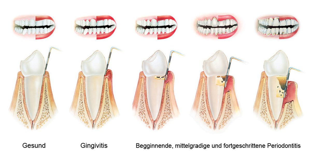 Dr. Zieger Zahnarzt Praxis Bonn Beuel Paradontitis